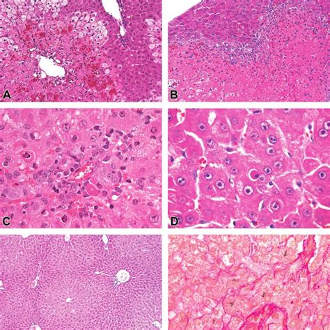 A An Example Of Zonal Necrosis In The Liver The Present Example Shows Download Scientific