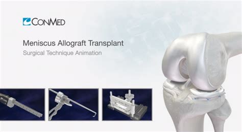 Meniscus Allograft Transplant Surgical Technique Medhold Medical