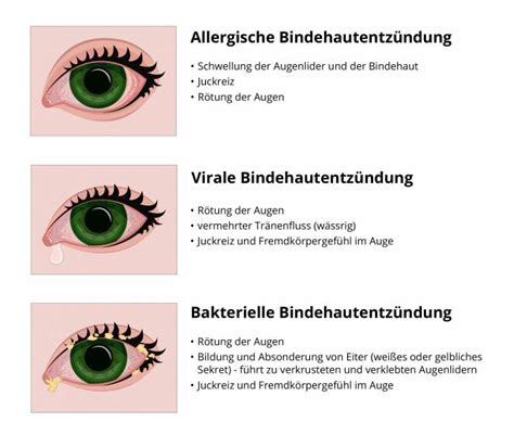 Welche Anzeichen deuten auf eine Bindehautentzündung hin