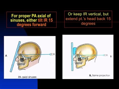 Rad 1120 Pa Axial Caldwell Method Sinuses Flashcards Quizlet