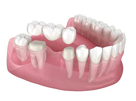 Puente Dental De Zirconia En M Xico Dentistas Certificados Por La Junta