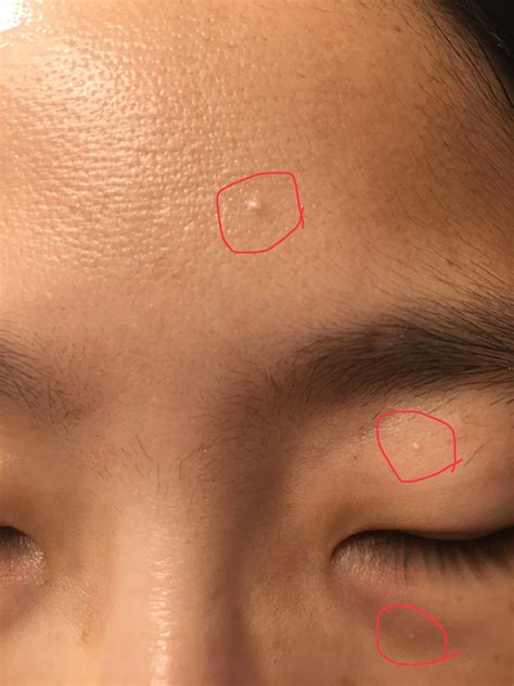 Skin Concern Milia Or Something Else Rskincareaddiction