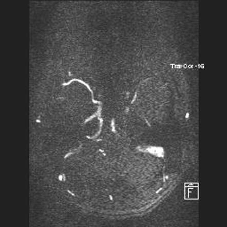 Dural Venous Sinus Thrombosis Image Radiopaedia Org