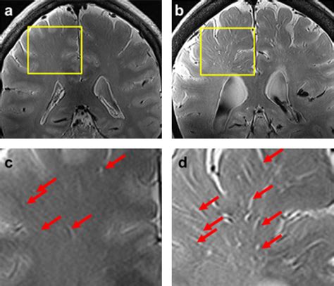 The Observation Of Brain Perivascular Spaces A Representative Slice Of