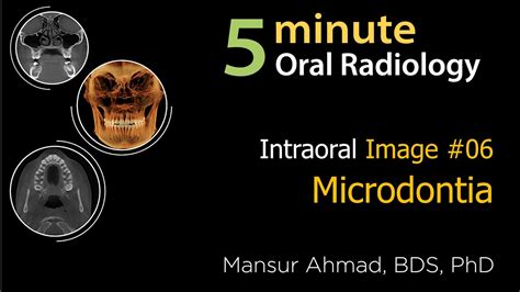 Microdontia: Intraoral Radiographic Interpretation - YouTube