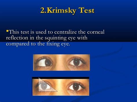 Squint Assessment