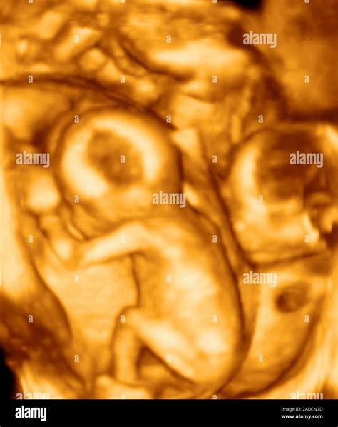 3D ultrasound scan of triplet foetuses at 15 weeks. Non-identical ...