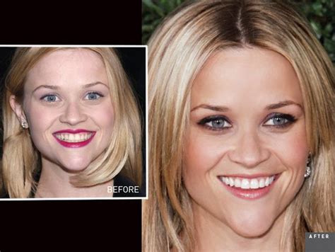 Pictures Of Reese Witherspoon S Smile Celebrity Dailybeauty The Beauty Authority Newbeauty