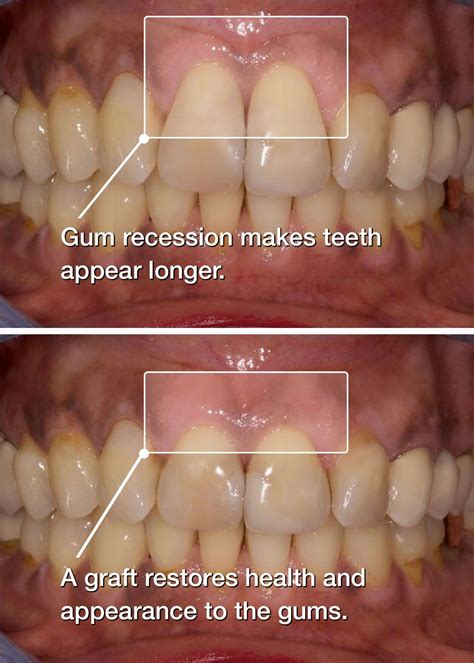 Receding Gums Surgery Before And After