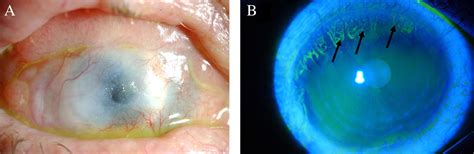 In Vivo Confocal Microscopic Findings In Patients With Limbal Stem Cell