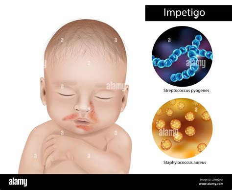 El impétigo es una infección causada por cepas de estafilococos o