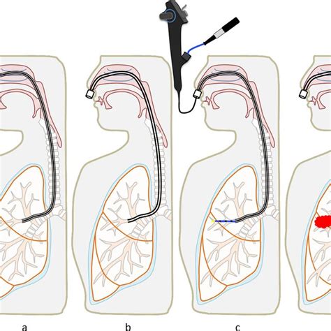 Wedged Tube Cryobiopsy A Advancement Of The Long Bronchial Tube Download Scientific Diagram