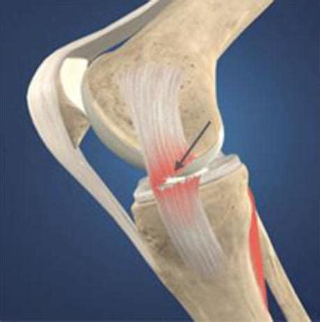 Medial collateral ligament tear (MCL) treatment | DR. RAJ KANNA