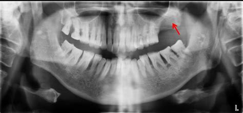 Oral Squamous Cell Carcinoma Radiology Cases