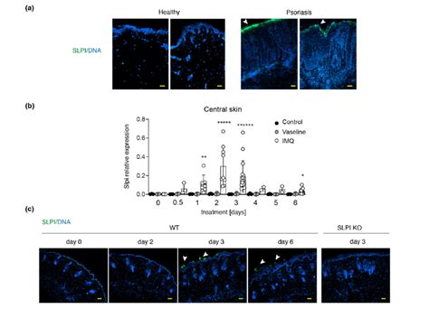 Secretory Leukocyte Protease Inhibitor Expression Increases In Lesional