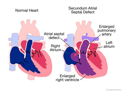 Heart Septal Defects, Atrial; Atrial Septal Defects; Persistent Ostium Primum