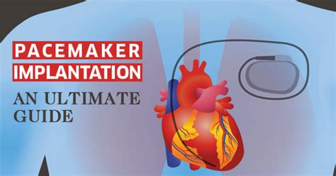 Types of Pacemaker — Heart Specialist Doctor | by Drrakeshjainindore ...