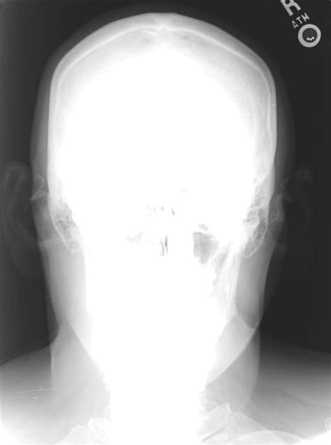 Idiopathic Bilateral Auricular Ossificans Mdedge Dermatology