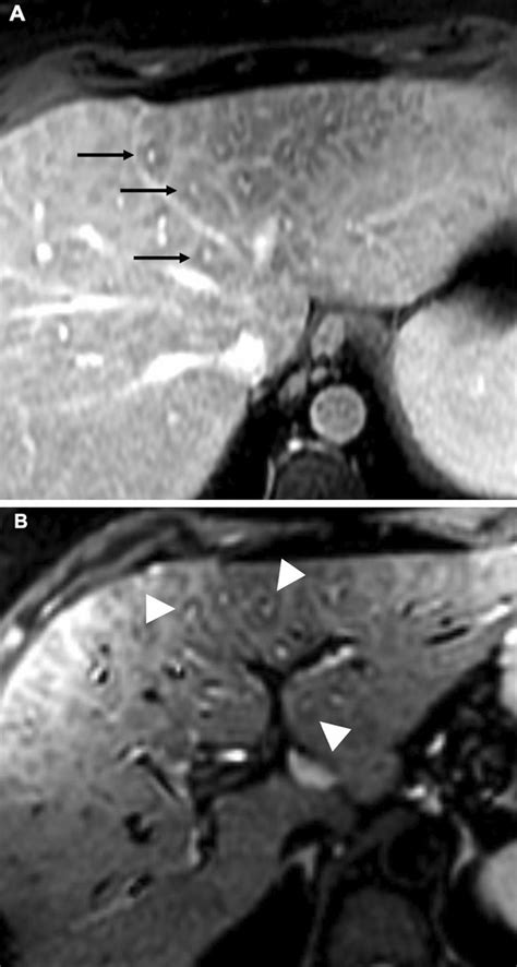 A B Periportal Halo 42 Year Old Woman With Ama Primary Biliary Download Scientific Diagram