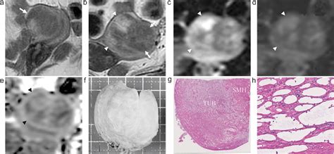 PDF MR Imaging Findings Of Uterine Adenomatoid Tumors Semantic Scholar