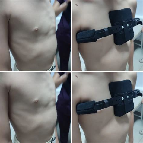 Pectus Carinatum Brace Ufuk Stent