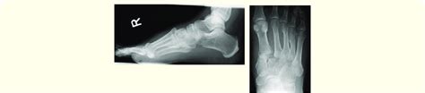 Xr Left Foot Lateral View With Prominence In The Tmt Joint Line Ap