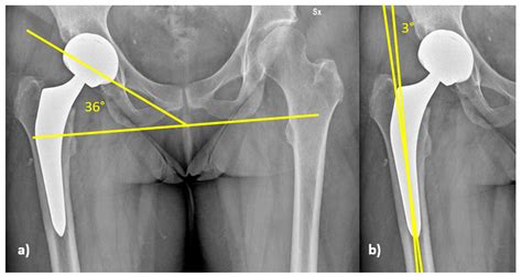 Is the Direct Anterior Approach for Total Hip Arthroplasty Effective in