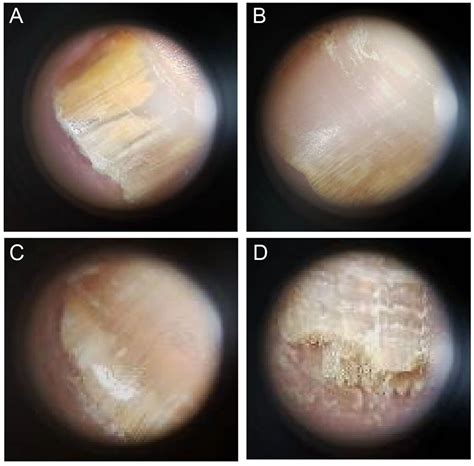 Patrones Dermatosc Picos En Pacientes Con Diagn Stico Cl Nico De