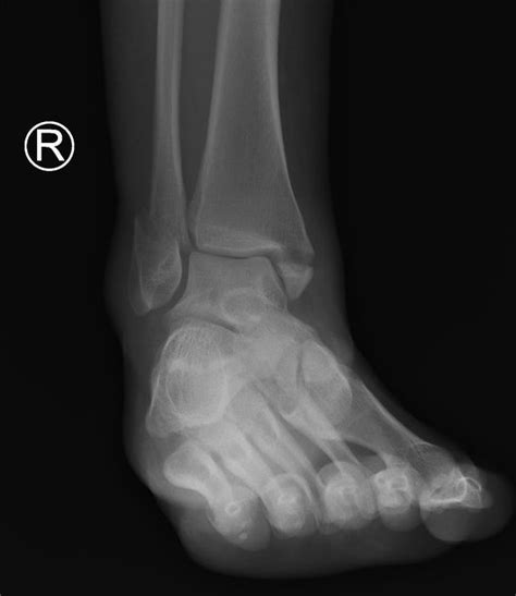 Bimalleolar Ankle Fracture Radiology Case Ankle