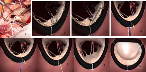 2a Implantation Of The Artificial Neo Chordae Cv4 At The Top Of The Download Scientific