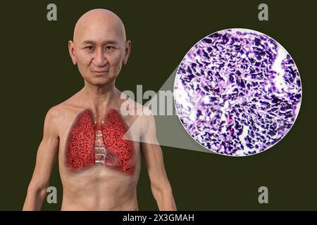 Illustration Of A Man With Smoker S Lungs Along With A Micrograph