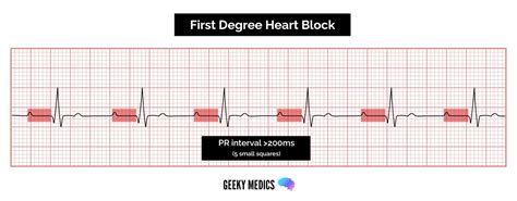 Atrioventricular Block Heart Block Geeky Medics