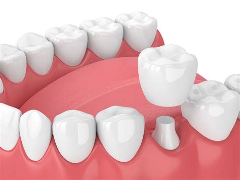 Advantages Of Dental Crown Treatment Ellicott City Md Dentist