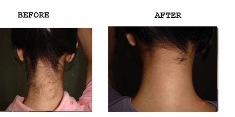 Back Of Neck Hair Removal Photo Amrit Clinic