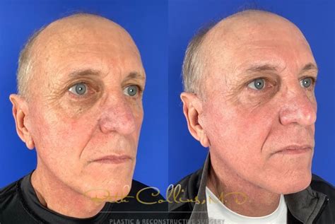 Botox Cosmetic Before And After Pictures Case Guilford Ct