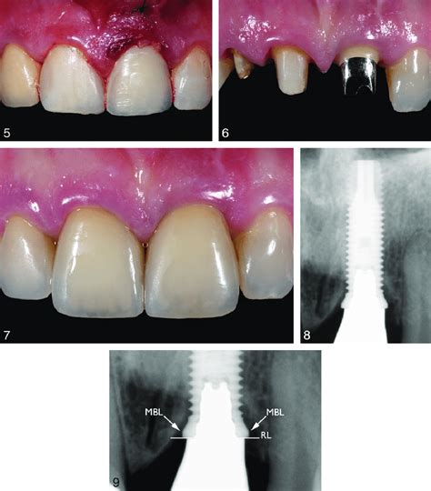 Labial View Of The Provisional Restoration And Connective Tissue Graft