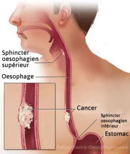 Cancer De L Oesophage Reflux Gastro Oesophagien Reflux Gastrique