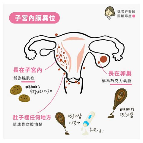 魏君卉醫師 婦科微創手術 圖解 子宮內膜異位症，究竟是啥米