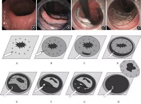图解不同类型的肠息肉内镜下切除术 MedSci cn