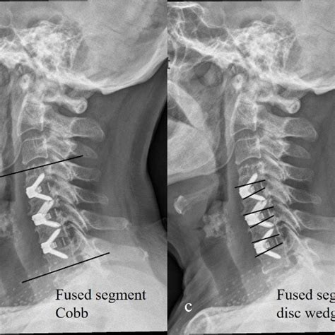 Illustration Showing The Method Of Cervical Sagittal Alignment Download Scientific Diagram