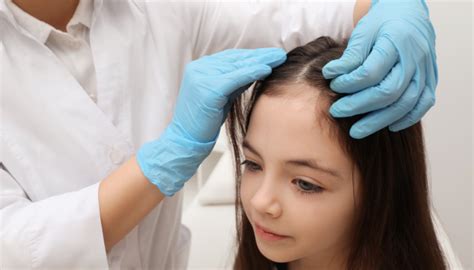 Head Lice Symptoms Prevention Treatment Guides