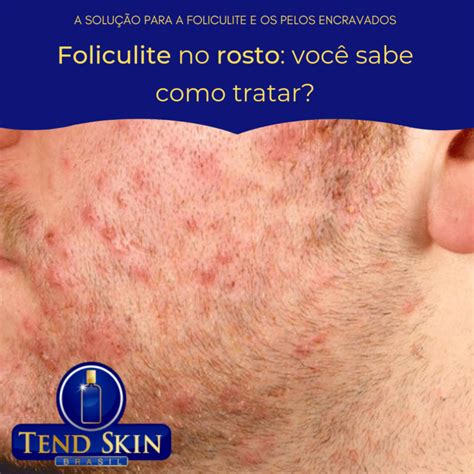 Foliculite No Rosto Voc Sabe Como Tratar Dr Foliculite Tend