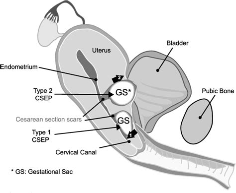 Cesarean Scar Ectopic Pregnancy Current Management Strategies 108458