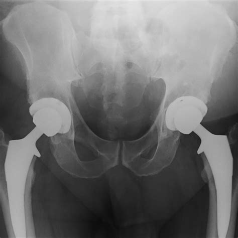 Case 1 Postoperative Antero Posterior Pelvis Radiograph Demonstrating Download Scientific