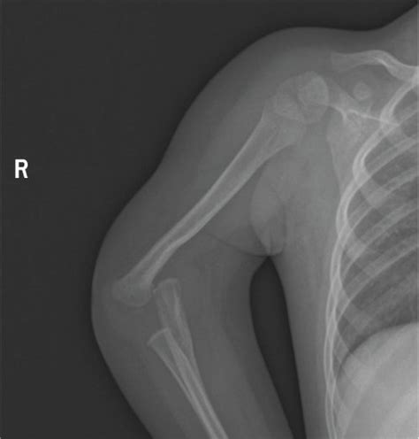 Clinical Images Of The Lrs Patient A Patient Ii The Lrs Probands