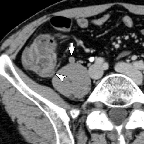 New Ct Criterion For Acute Appendicitis Maximum Depth Of Intraluminal