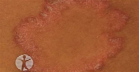 Psoriasis image