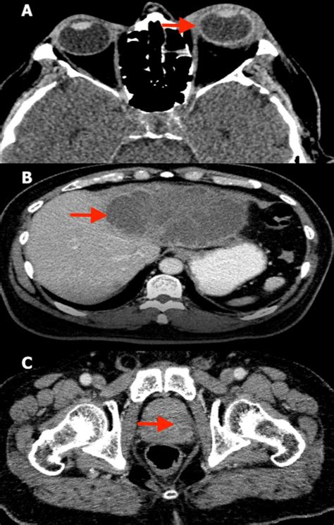 Contrast Enhanced Computed Tomography Cect Scans A Cect Orbit Shows