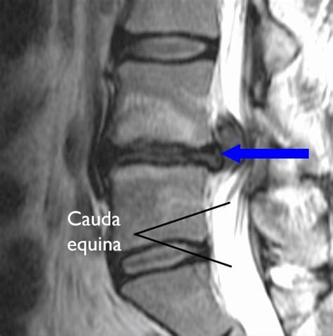 Cauda Equina Syndrome Tumor