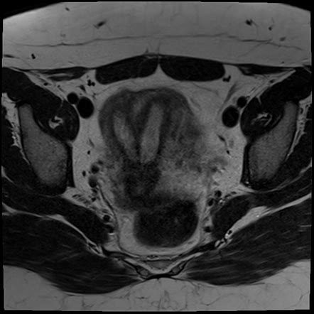 Septate Uterus Radiology Case Radiopaedia Org